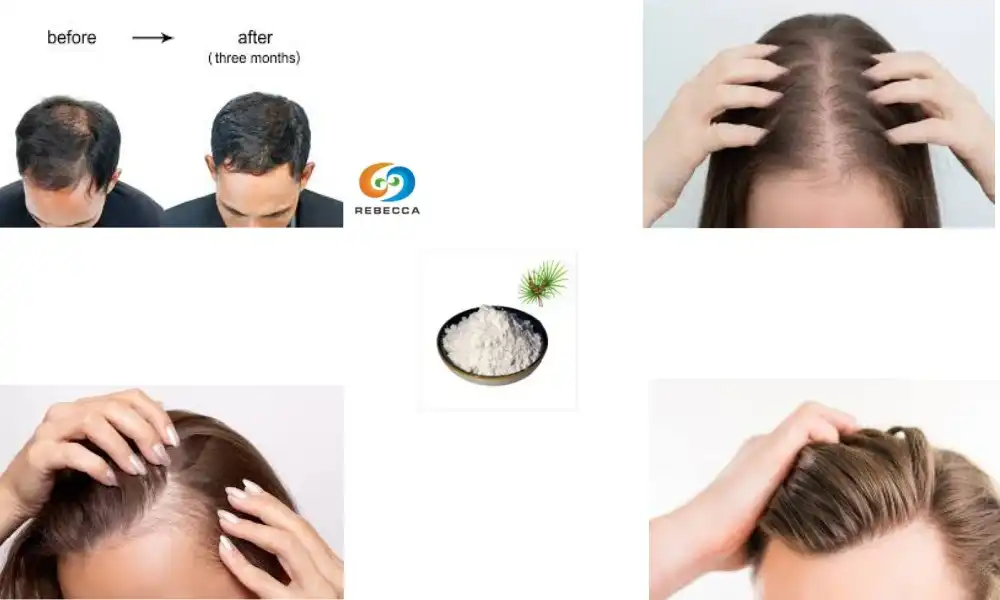 Can saw palmetto extract regrow hair?